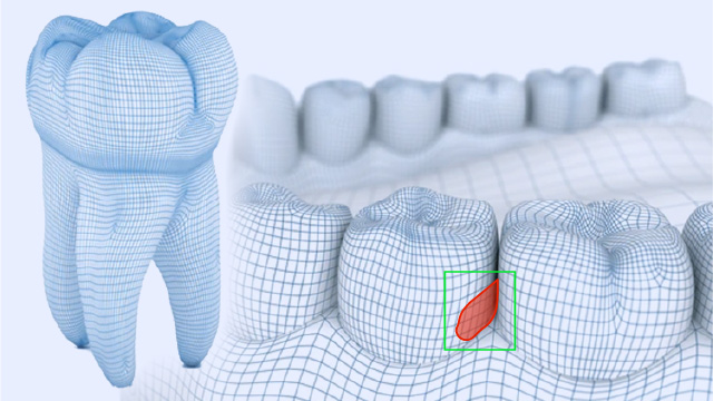 Custom 3D Computer Vision software for dental diagnostics and reconstruction
